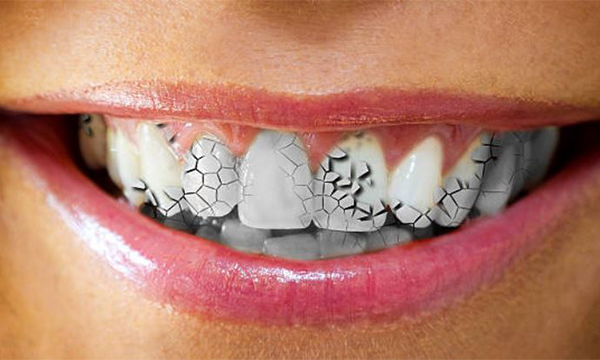 Craze Lines Teeth Treatment