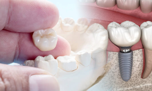 Differences between crowns and implants