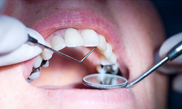 preventing root canals