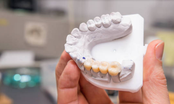 can teeth under a dental bridge become infected?