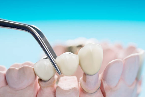 How long does a dental bridge last?