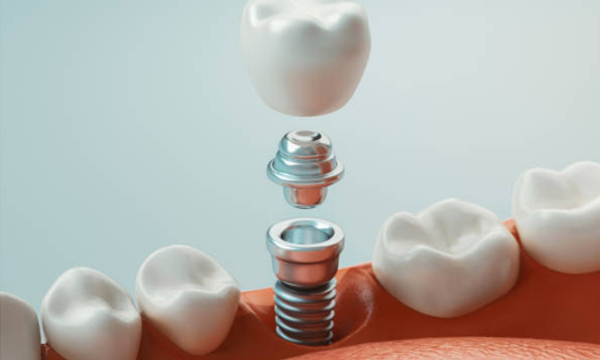 Dental Implants